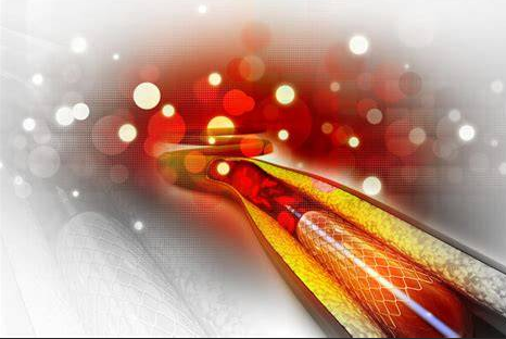 EF≤35%有存活心肌的冠心病患者，介入治疗未获益！REVIVED-BCIS2研究