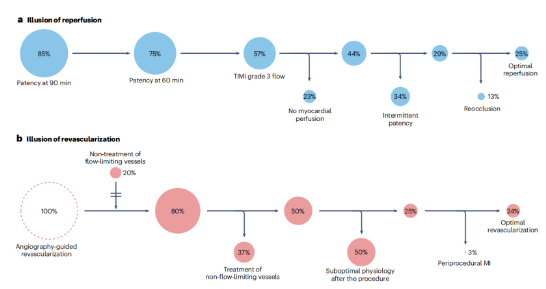造影看到的冠脉介入成功，可能是“幻觉”！？上海交大涂圣贤等多国学者文章